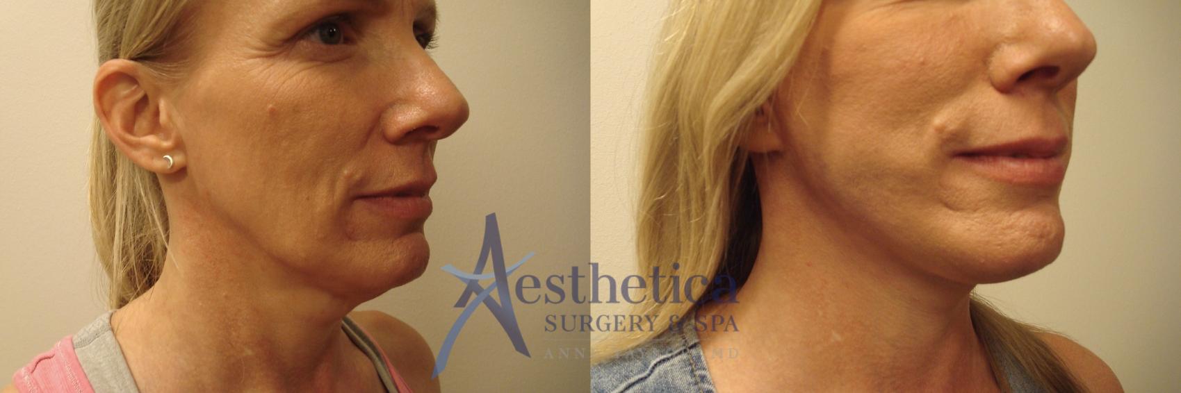 Facelift Case 638 Before & After Right Side | Columbus, OH | Aesthetica Surgery & Spa