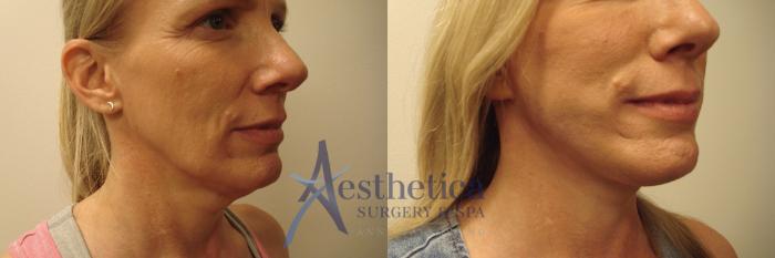 Facelift Case 638 Before & After Right Side | Columbus, OH | Aesthetica Surgery & Spa