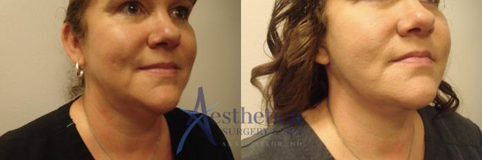 Facelift Case 646 Before & After Right Oblique | Columbus, OH | Aesthetica Surgery & Spa