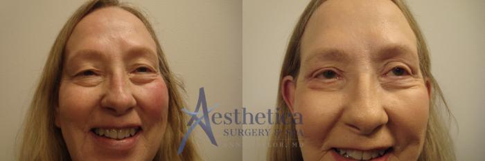 Facelift Case 655 Before & After Front | Columbus, OH | Aesthetica Surgery & Spa