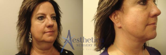 Facelift Case 660 Before & After Front | Columbus, OH | Aesthetica Surgery & Spa