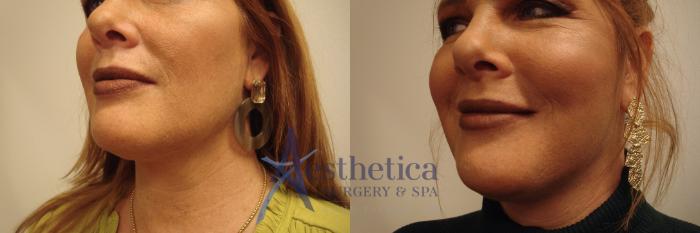 Facelift Case 676 Before & After Right Oblique | Columbus, OH | Aesthetica Surgery & Spa