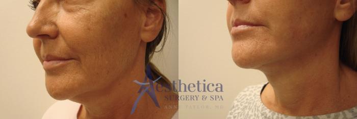 Facelift Case 677 Before & After Left Oblique | Columbus, OH | Aesthetica Surgery & Spa