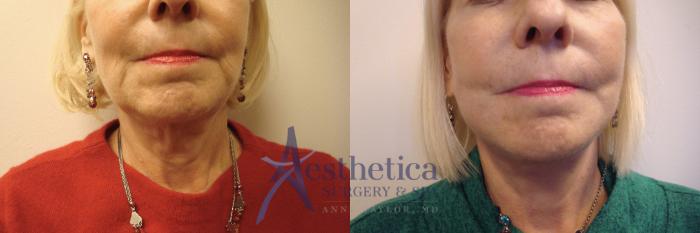 Facelift Case 684 Before & After Front | Columbus, OH | Aesthetica Surgery & Spa