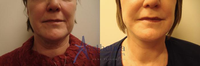 Facelift Case 697 Before & After Front | Columbus, OH | Aesthetica Surgery & Spa