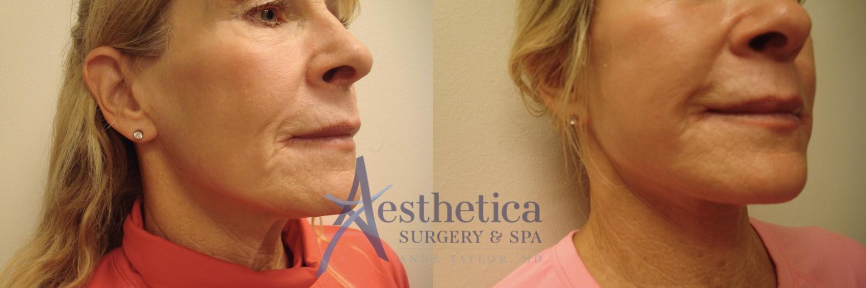 Facelift Case 704 Before & After Right Oblique | Columbus, OH | Aesthetica Surgery & Spa