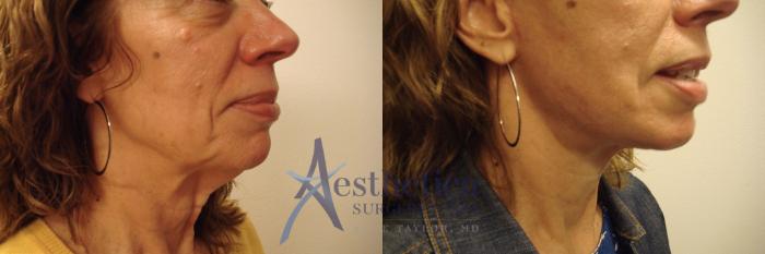 Facelift Case 710 Before & After Right Side | Columbus, OH | Aesthetica Surgery & Spa