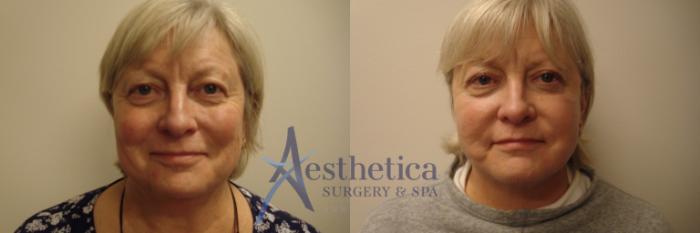 Facelift Case 713 Before & After Front | Columbus, OH | Aesthetica Surgery & Spa