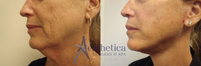 Facelift Case 714 Before & After Left Oblique | Columbus, OH | Aesthetica Surgery & Spa
