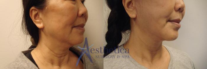 Facelift Case 722 Before & After Right Side | Columbus, OH | Aesthetica Surgery & Spa