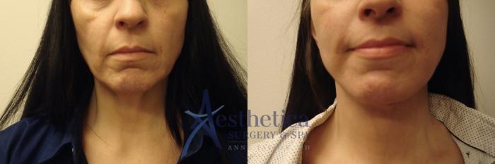 Facelift Case 724 Before & After Front | Columbus, OH | Aesthetica Surgery & Spa