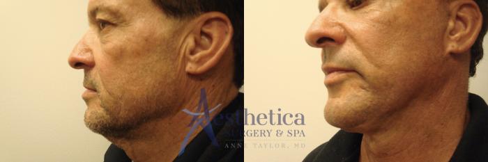 Facelift Case 725 Before & After Left Side | Columbus, OH | Aesthetica Surgery & Spa