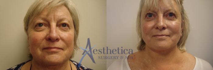 Facelift Case 729 Before & After Front | Columbus, OH | Aesthetica Surgery & Spa