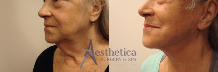 Facelift Case 731 Before & After Right Side | Columbus, OH | Aesthetica Surgery & Spa
