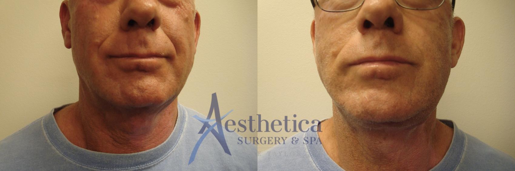 Facelift Case 735 Before & After Front | Columbus, OH | Aesthetica Surgery & Spa