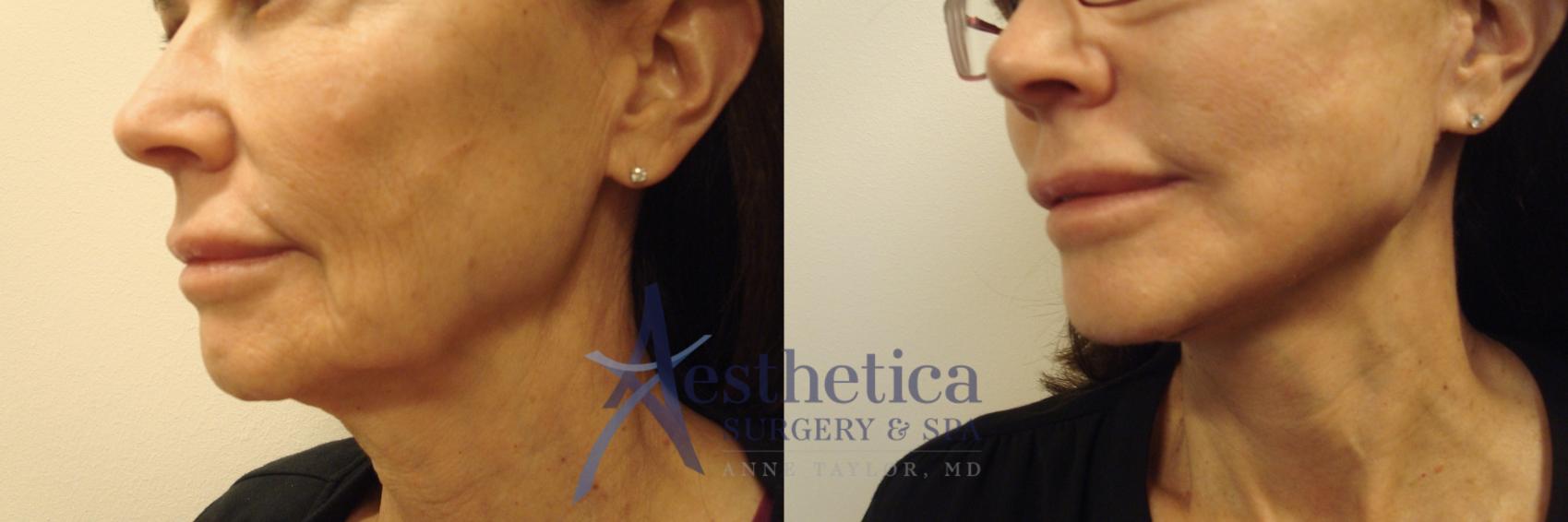 Facelift Case 736 Before & After Left Side | Columbus, OH | Aesthetica Surgery & Spa