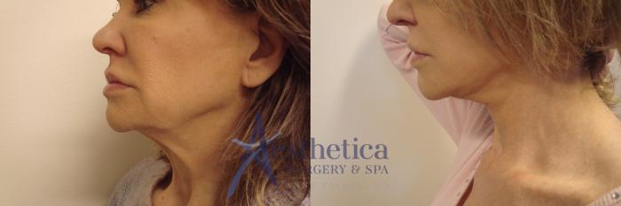 Facelift Case 739 Before & After Left Side | Columbus, OH | Aesthetica Surgery & Spa