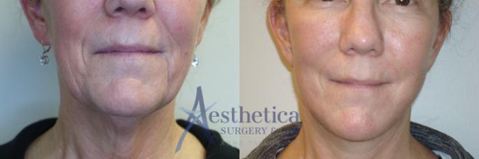 Facelift Case 768 Before & After Front | Columbus, OH | Aesthetica Surgery & Spa