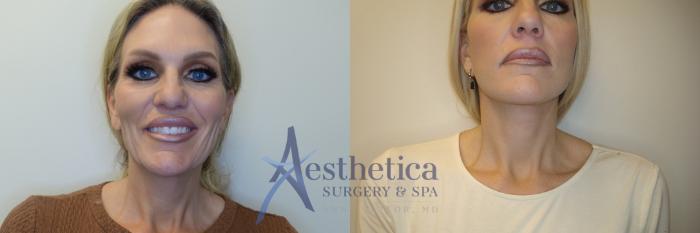 Facelift Case 769 Before & After Front | Columbus, OH | Aesthetica Surgery & Spa