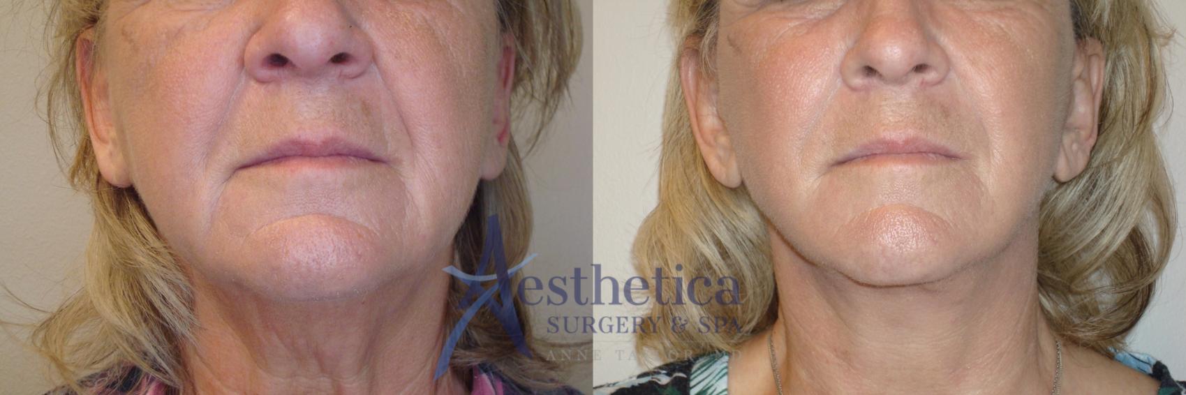 Facelift Case 801 Before & After Front | Columbus, OH | Aesthetica Surgery & Spa