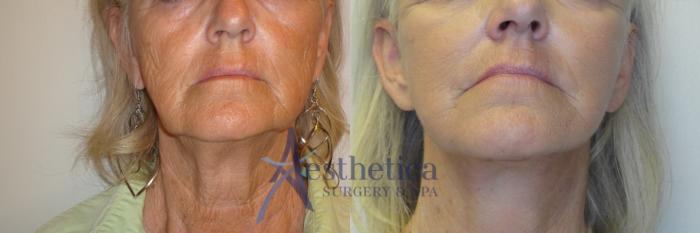 Facelift Case 814 Before & After Front | Columbus, OH | Aesthetica Surgery & Spa