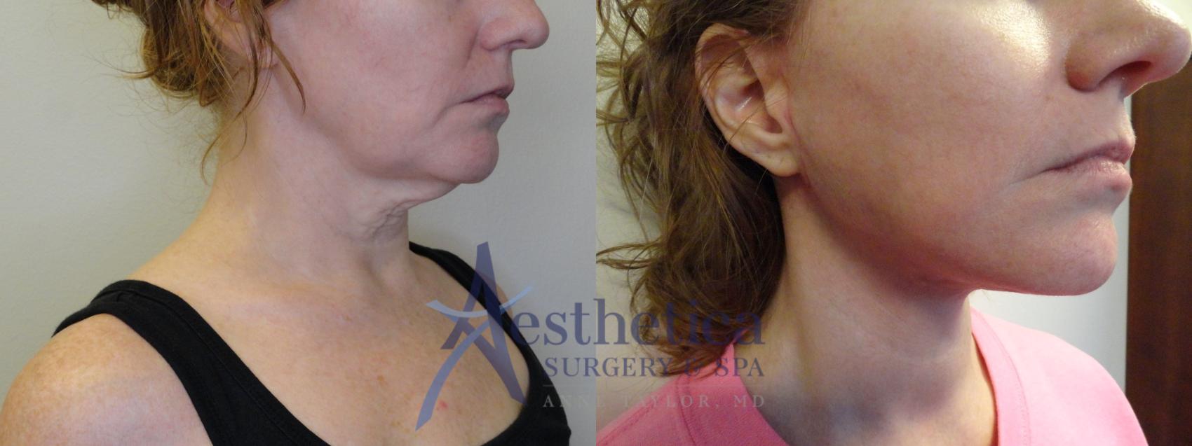 Facelift Case 820 Before & After Right Oblique | Columbus, OH | Aesthetica Surgery & Spa