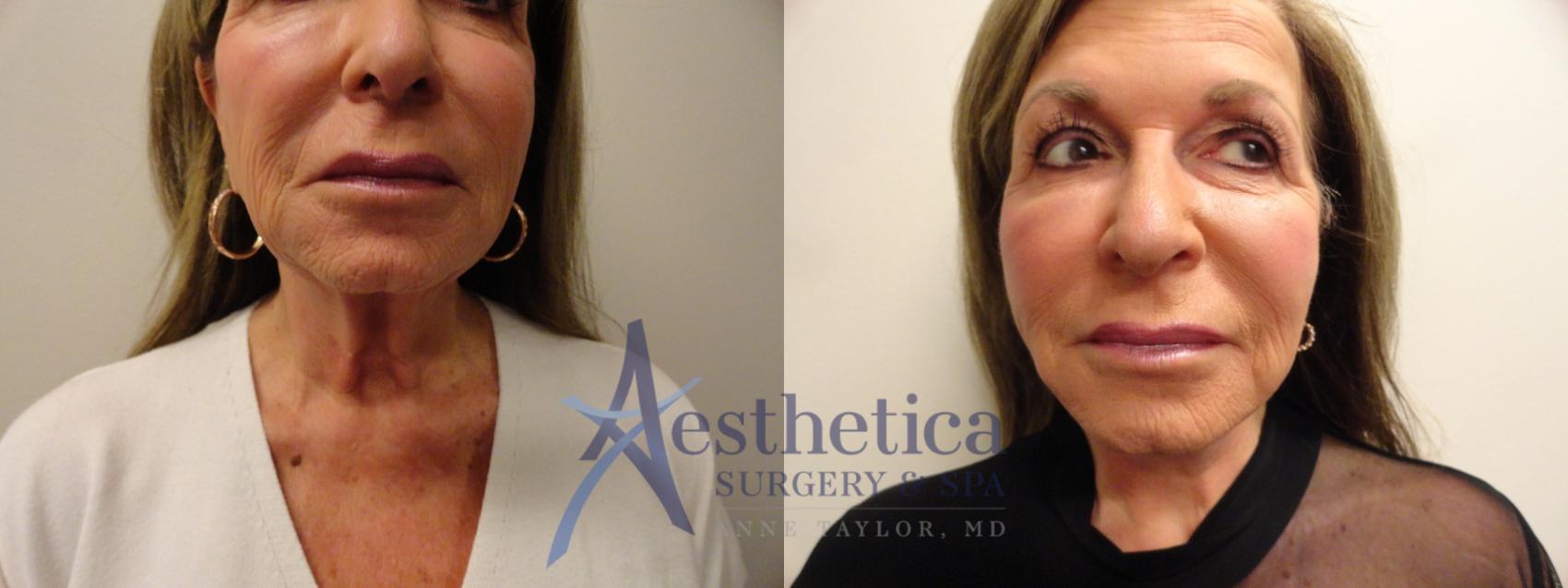 Facelift Case 865 Before & After Front | Columbus, OH | Aesthetica Surgery & Spa