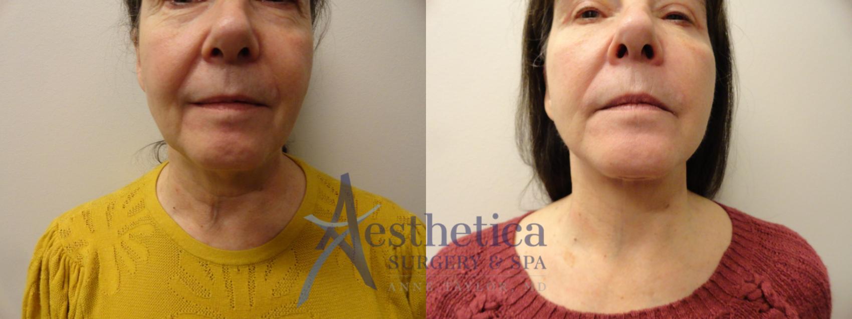 Facelift Case 870 Before & After Front | Columbus, OH | Aesthetica Surgery & Spa