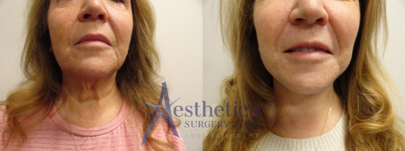 Facelift Case 872 Before & After Front | Columbus, OH | Aesthetica Surgery & Spa