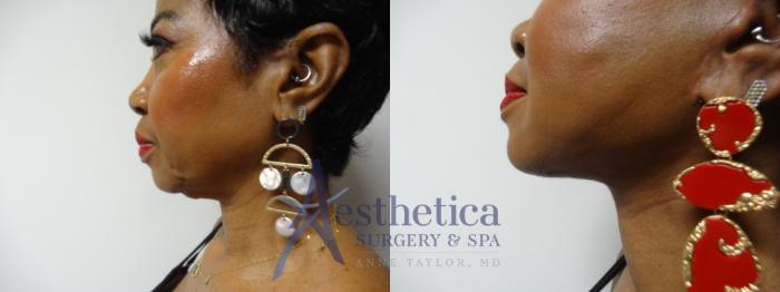Facelift Case 879 Before & After Left Side | Columbus, OH | Aesthetica Surgery & Spa