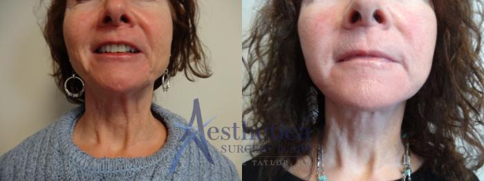 Facelift Case 880 Before & After Front | Columbus, OH | Aesthetica Surgery & Spa