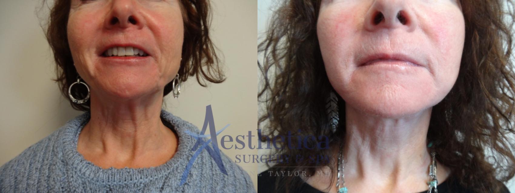 Facelift Case 881 Before & After Front | Columbus, OH | Aesthetica Surgery & Spa