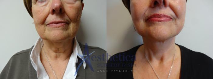 Facelift Case 882 Before & After Front | Columbus, OH | Aesthetica Surgery & Spa