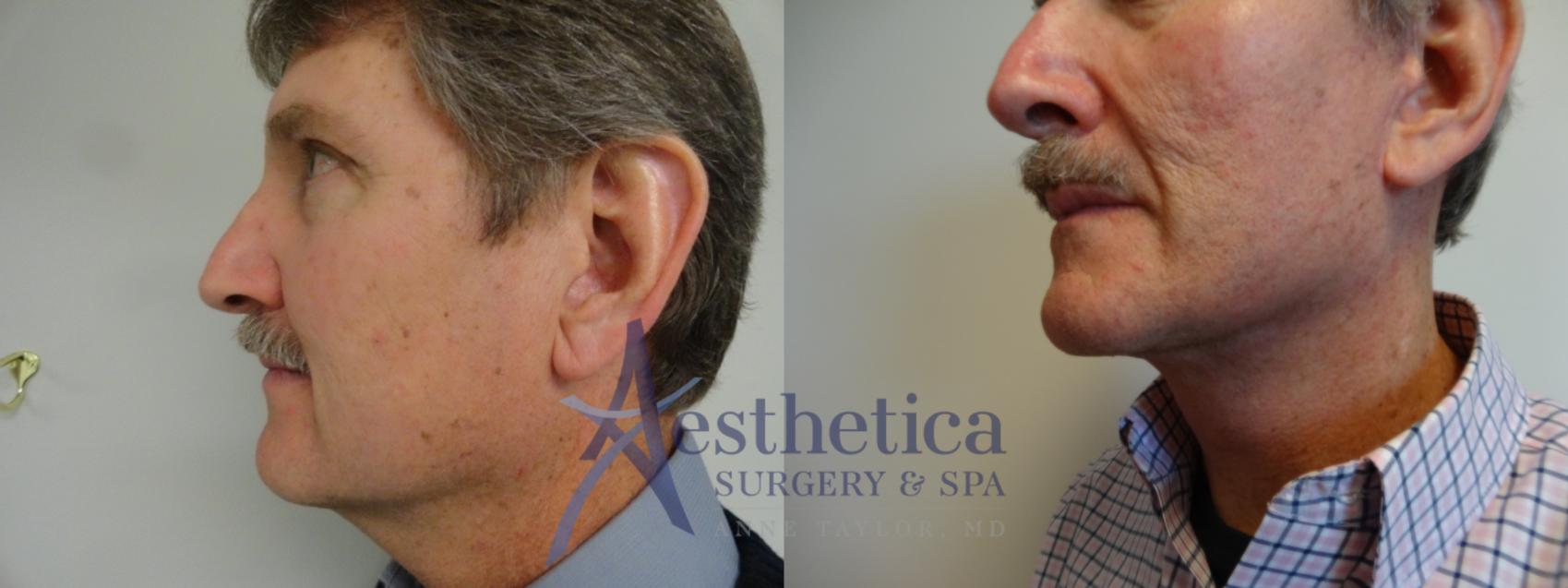 Facelift Case 898 Before & After Left Side | Columbus, OH | Aesthetica Surgery & Spa