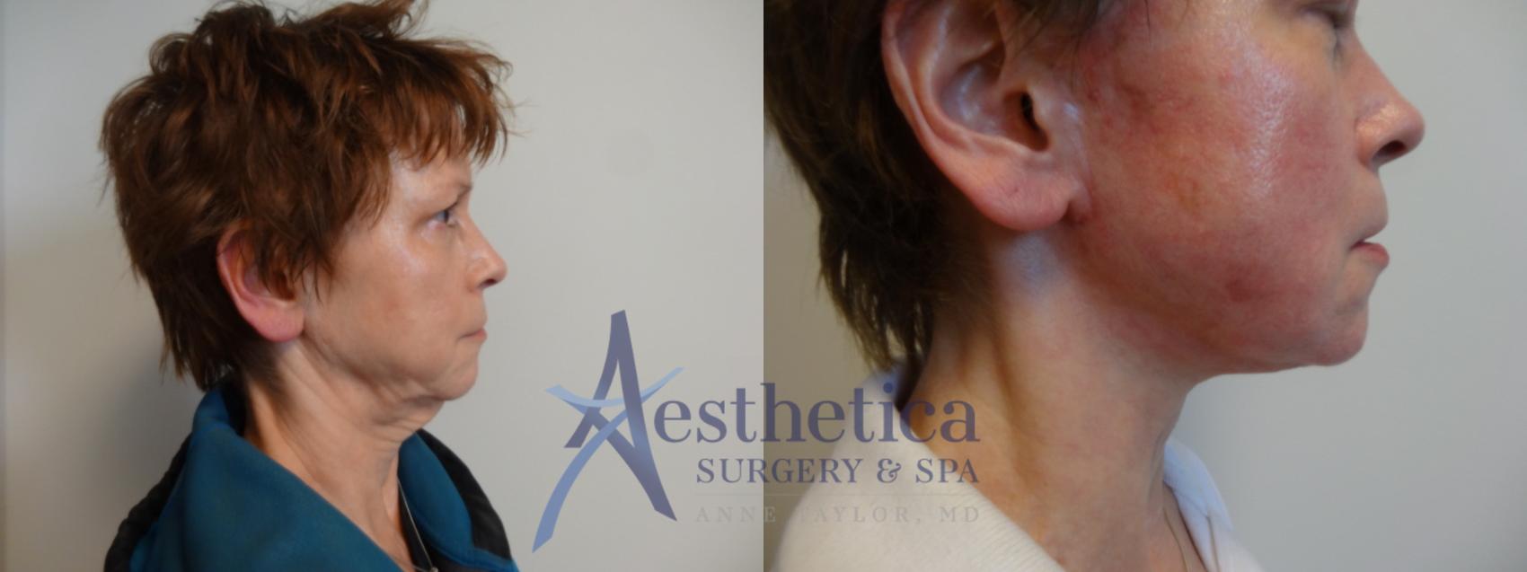 Facelift Case 903 Before & After Right Side | Columbus, OH | Aesthetica Surgery & Spa