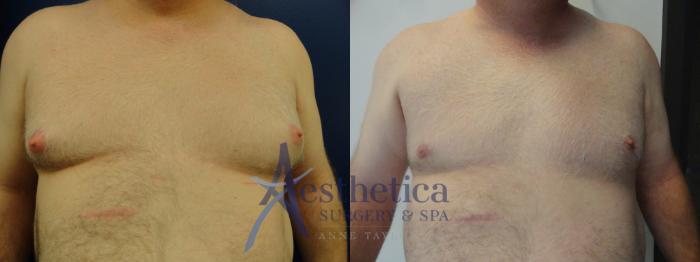 Gynecomastia Case 143 Before & After View #1 | Columbus, OH | Aesthetica Surgery & Spa