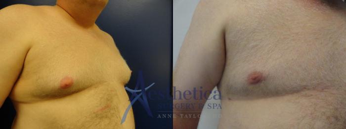 Gynecomastia Case 143 Before & After View #2 | Columbus, OH | Aesthetica Surgery & Spa