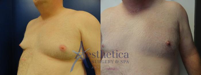 Gynecomastia Case 143 Before & After View #3 | Columbus, OH | Aesthetica Surgery & Spa