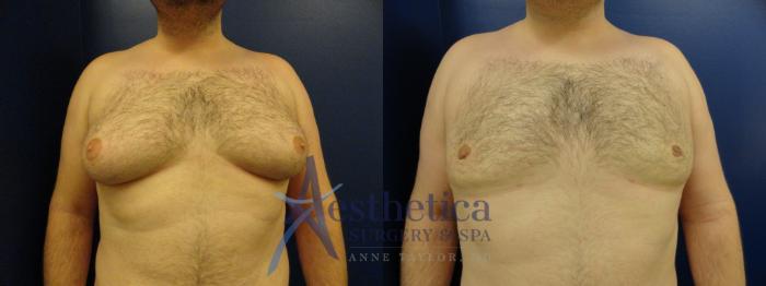 Gynecomastia Case 144 Before & After View #1 | Columbus, OH | Aesthetica Surgery & Spa