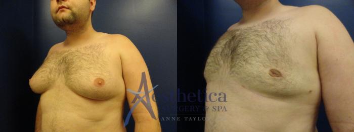 Gynecomastia Case 144 Before & After View #2 | Columbus, OH | Aesthetica Surgery & Spa