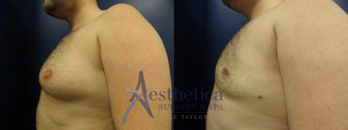 Gynecomastia Case 144 Before & After View #3 | Columbus, OH | Aesthetica Surgery & Spa