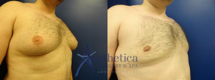 Gynecomastia Case 144 Before & After View #4 | Columbus, OH | Aesthetica Surgery & Spa