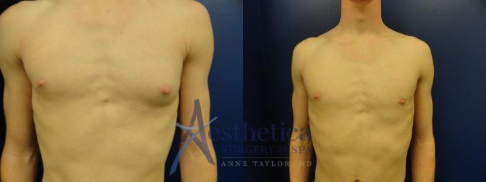 Gynecomastia Case 177 Before & After View #1 | Columbus, OH | Aesthetica Surgery & Spa