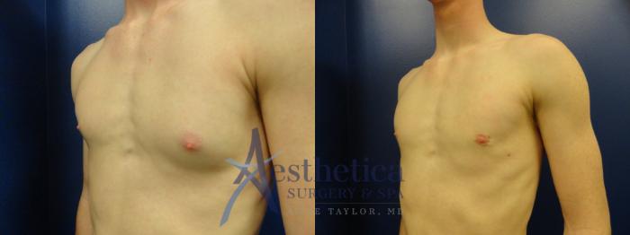 Gynecomastia Case 177 Before & After View #2 | Columbus, OH | Aesthetica Surgery & Spa