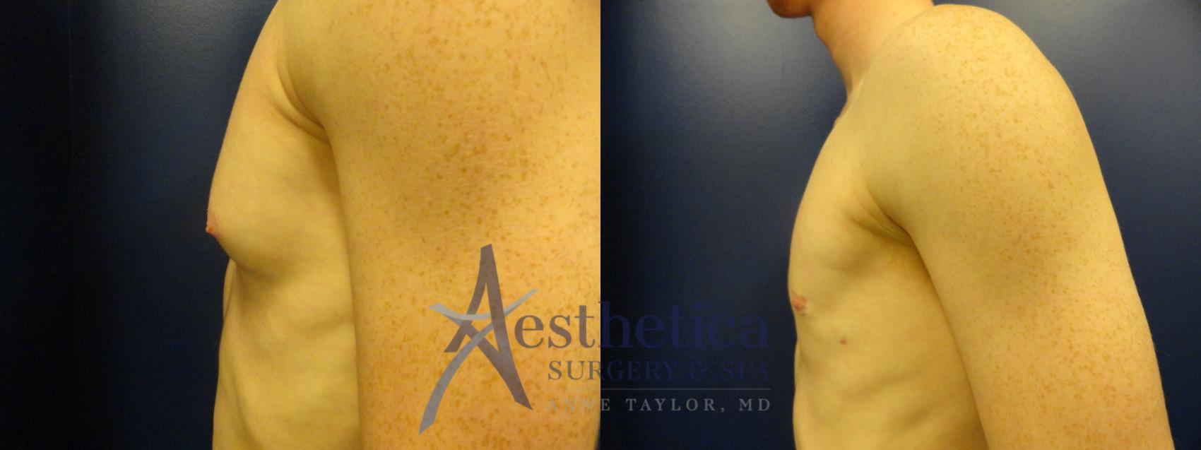 Gynecomastia Case 177 Before & After View #3 | Columbus, OH | Aesthetica Surgery & Spa