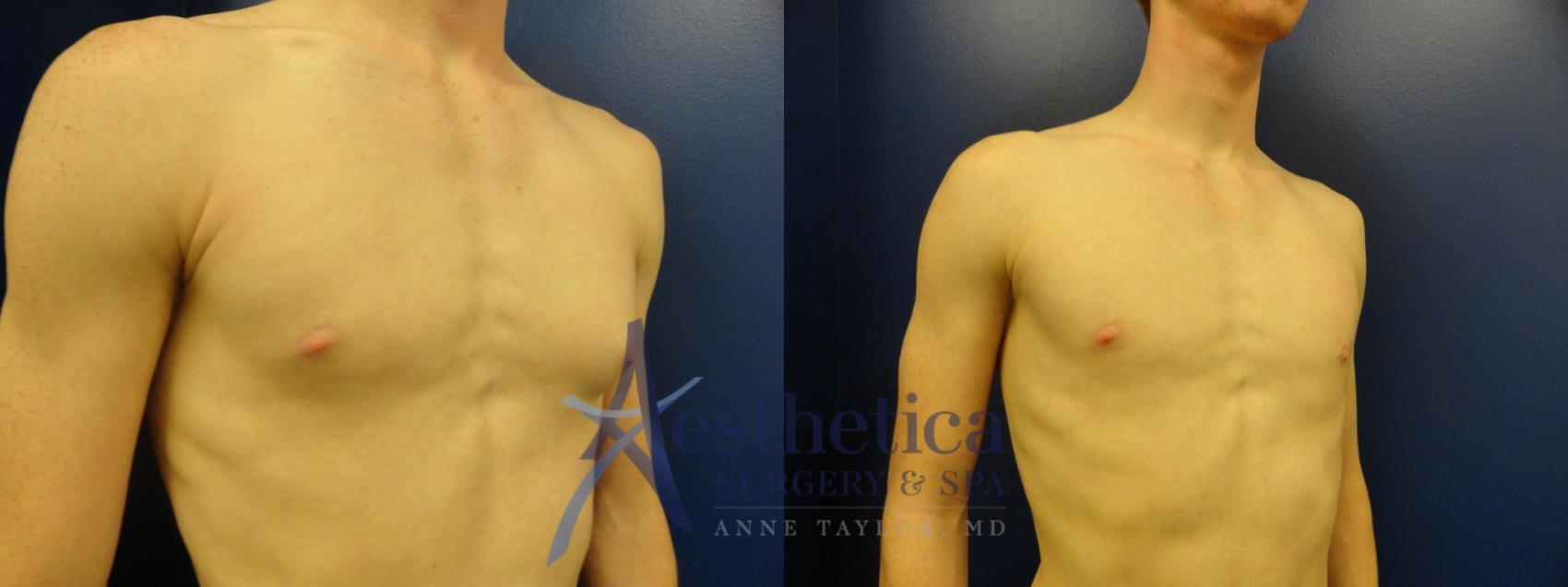 Gynecomastia Case 177 Before & After View #4 | Columbus, OH | Aesthetica Surgery & Spa