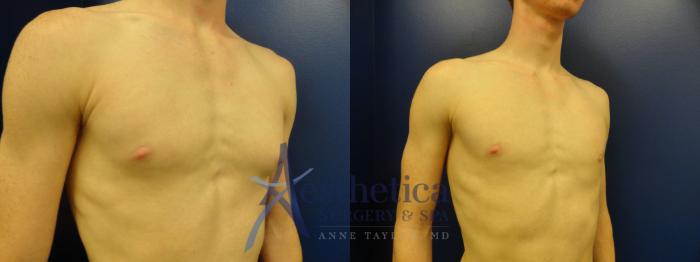 Gynecomastia Case 177 Before & After View #4 | Columbus, OH | Aesthetica Surgery & Spa