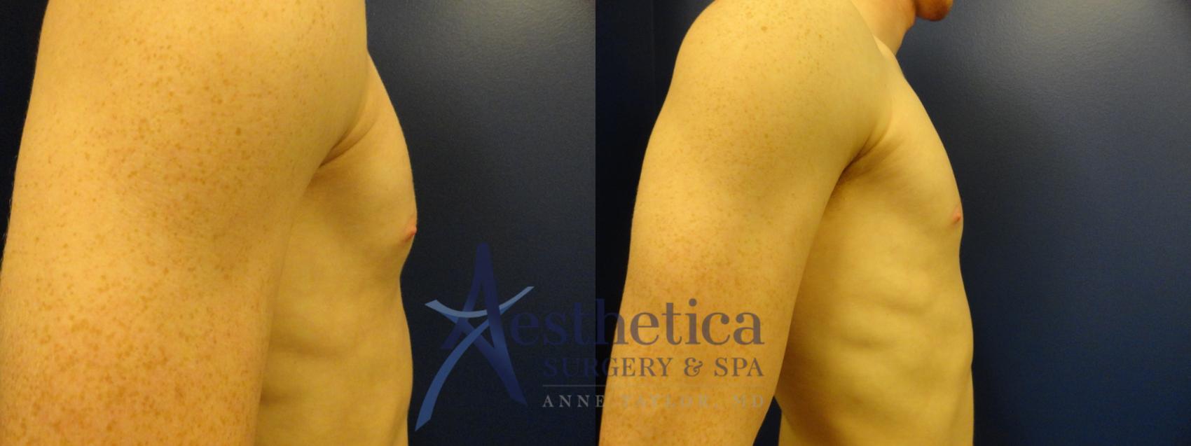 Gynecomastia Case 177 Before & After View #5 | Columbus, OH | Aesthetica Surgery & Spa