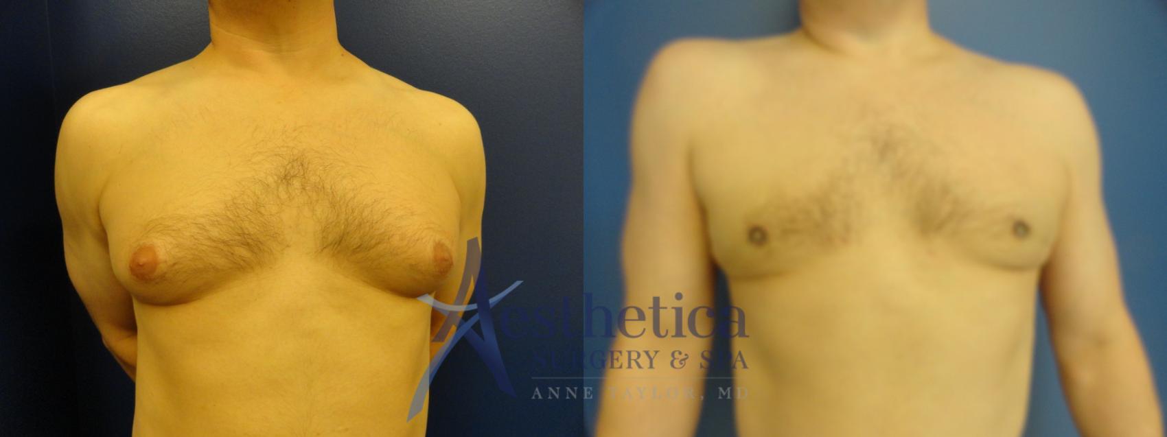 Gynecomastia Case 199 Before & After View #1 | Columbus, OH | Aesthetica Surgery & Spa