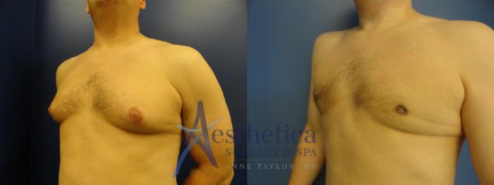 Gynecomastia Case 199 Before & After View #2 | Columbus, OH | Aesthetica Surgery & Spa